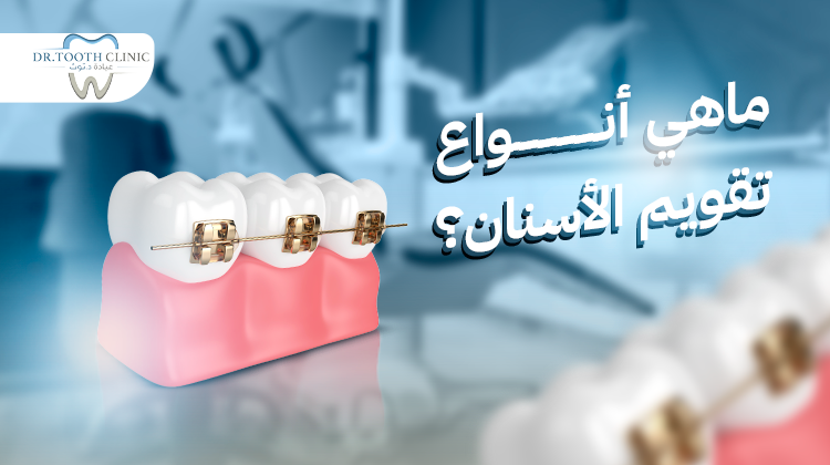 أنواع تقويم الأسنان
