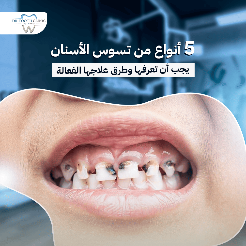 5 أنواع من تسوس الأسنان يجب أن تعرفها وطرق علاجها الفعالة