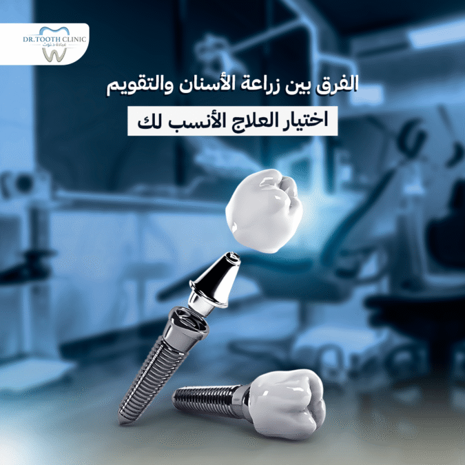 الفرق بين زراعة الاسنان والتقويم