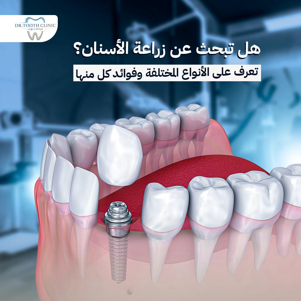 هل تبحث عن زراعة الأسنان؟ تعرف على الأنواع المختلفة وفوائد كل منها 