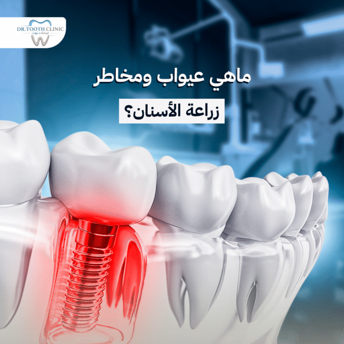 عيوب زراعة الأسنان