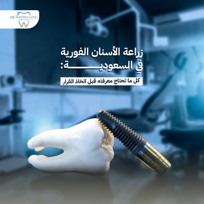 زراعة الاسنان الفورية