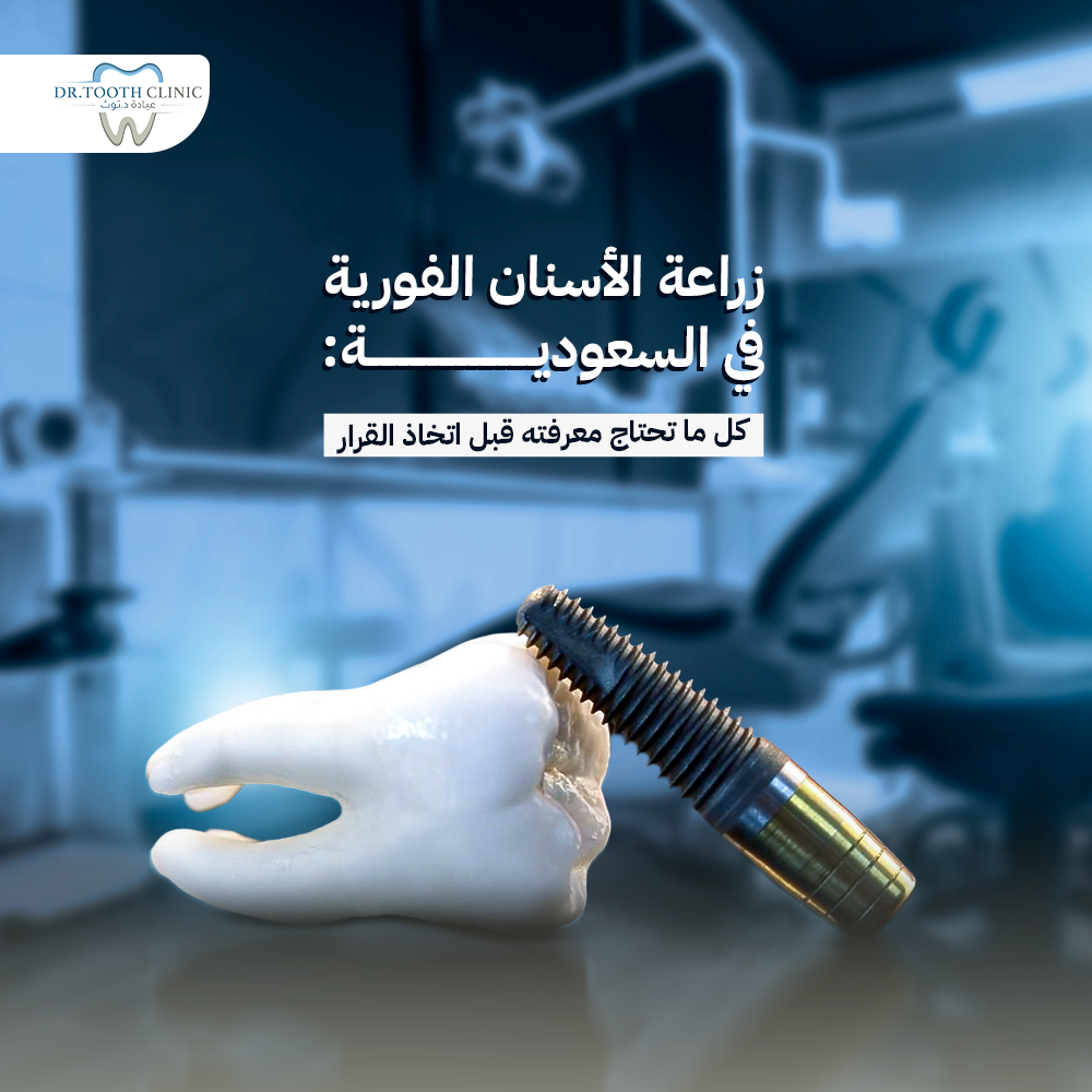 زراعة الأسنان الفورية في السعودية: كل ما تحتاج معرفته قبل اتخاذ القرار