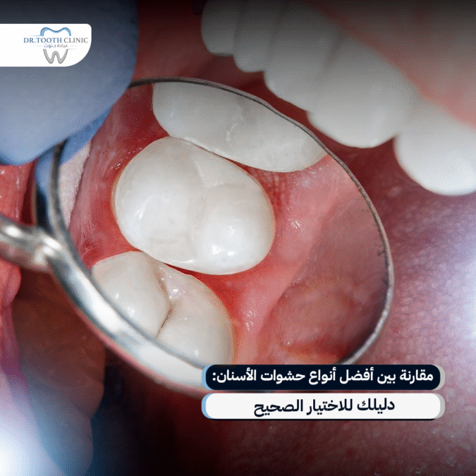 افضل انواع حشوات الاسنان