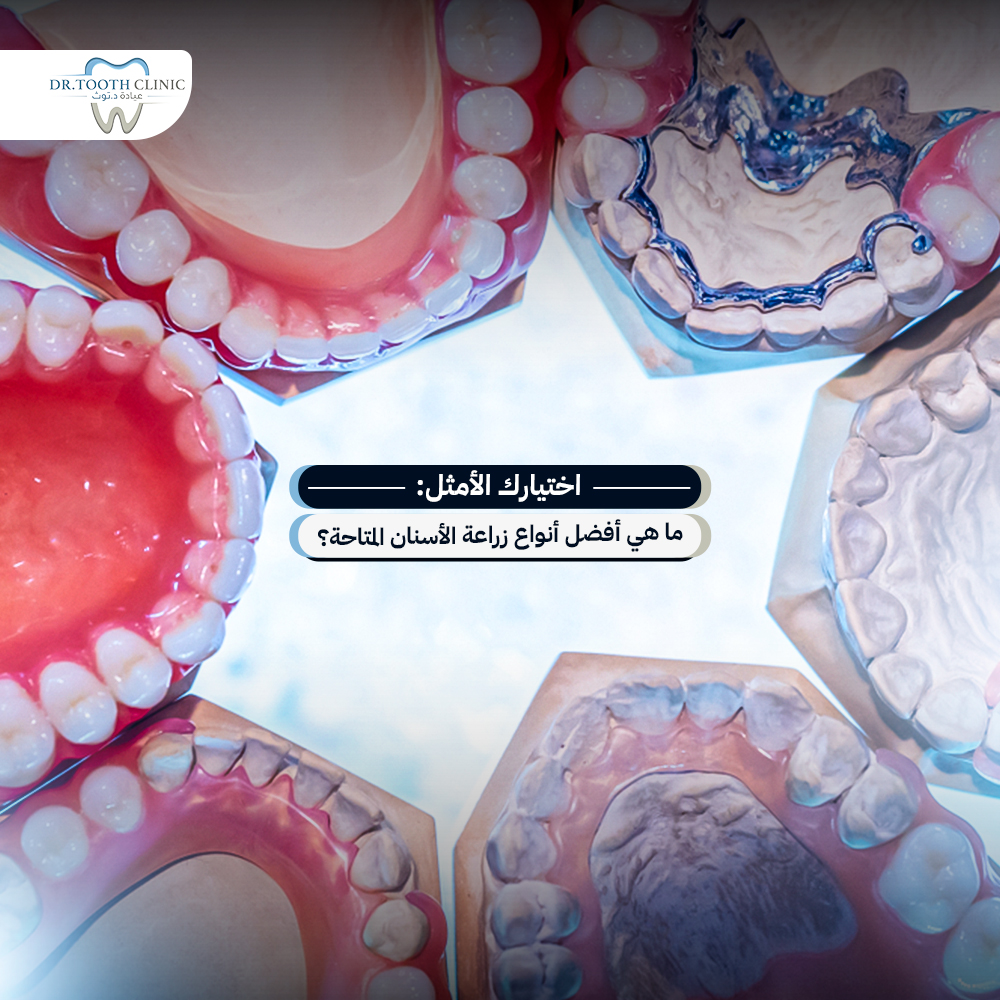 اختيارك الأمثل: ما هي افضل انواع زراعة الاسنان