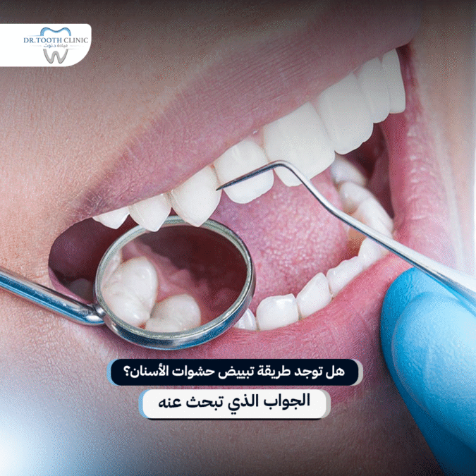 طريقة تبييض حشوات الاسنان