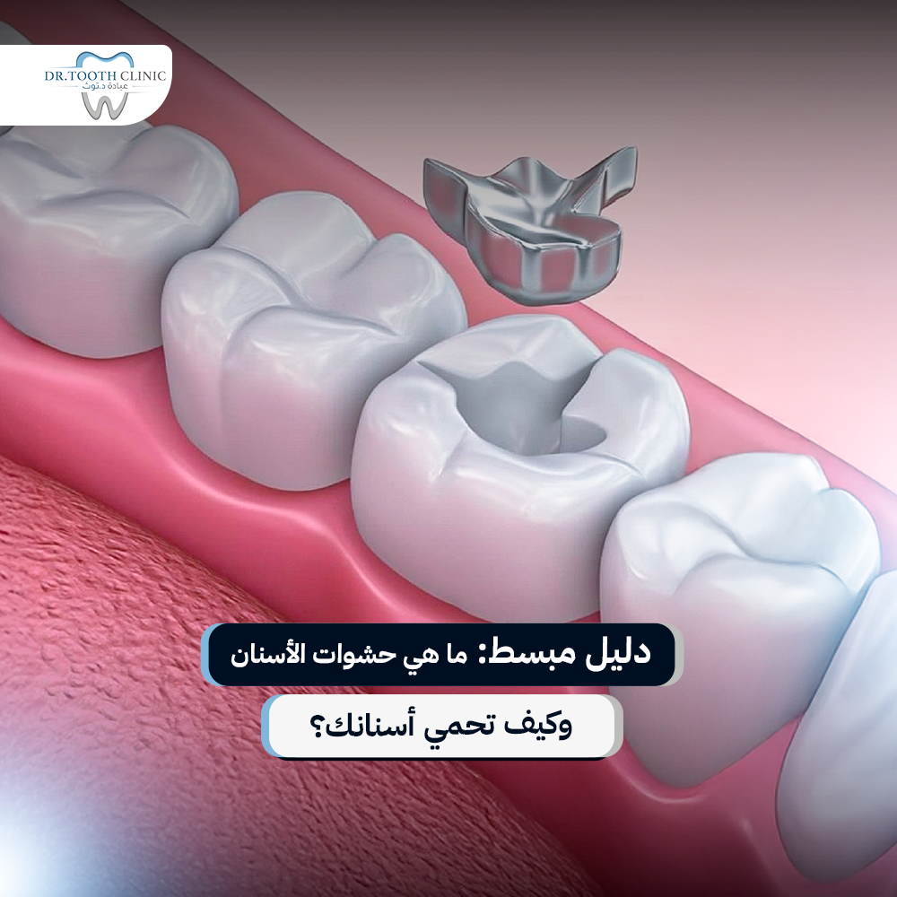 دليل مبسط: ما هي حشوات الاسنان وكيف تحمي أسنانك؟