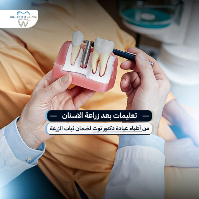 تعليمات بعد زراعة الاسنان