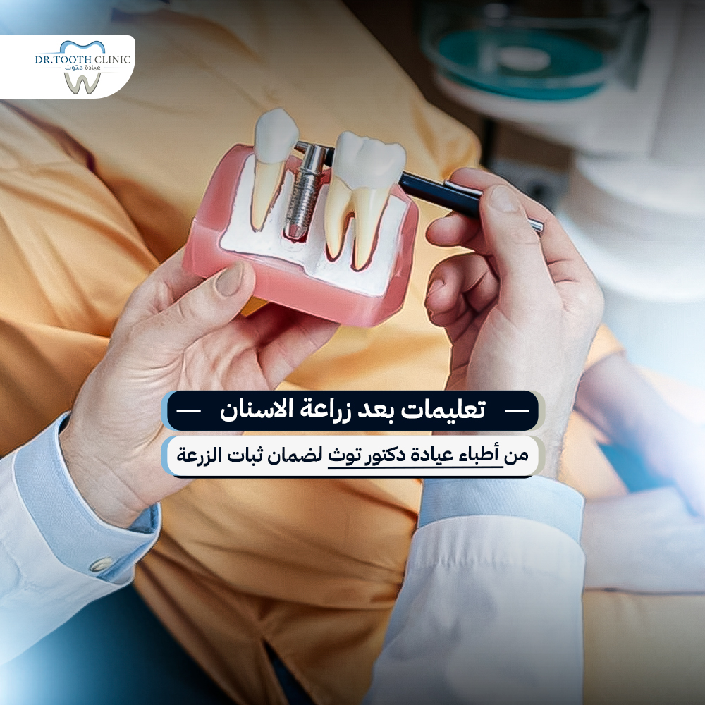 تعليمات بعد زراعة الاسنان من أطباء عيادة دكتور توث لضمان ثبات الزرعة