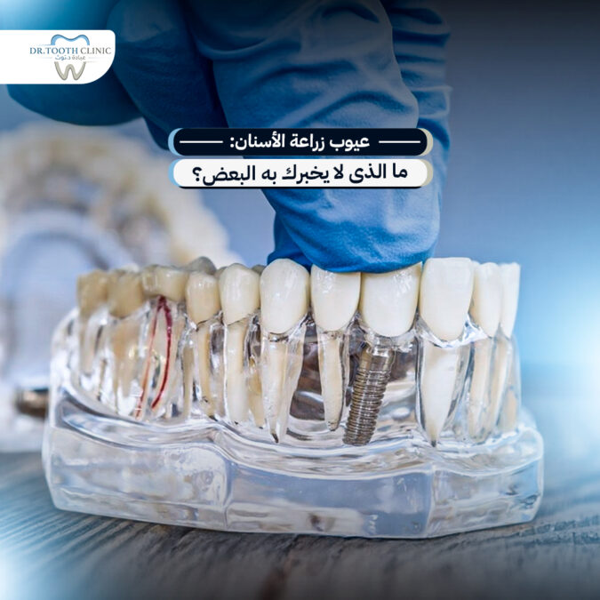 عيوب زراعة الأسنان