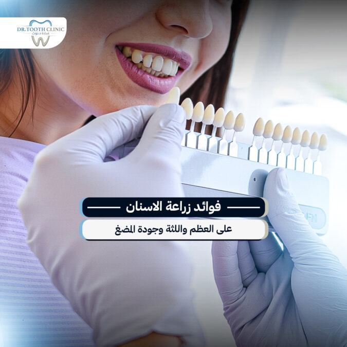 فوائد زراعة الاسنان