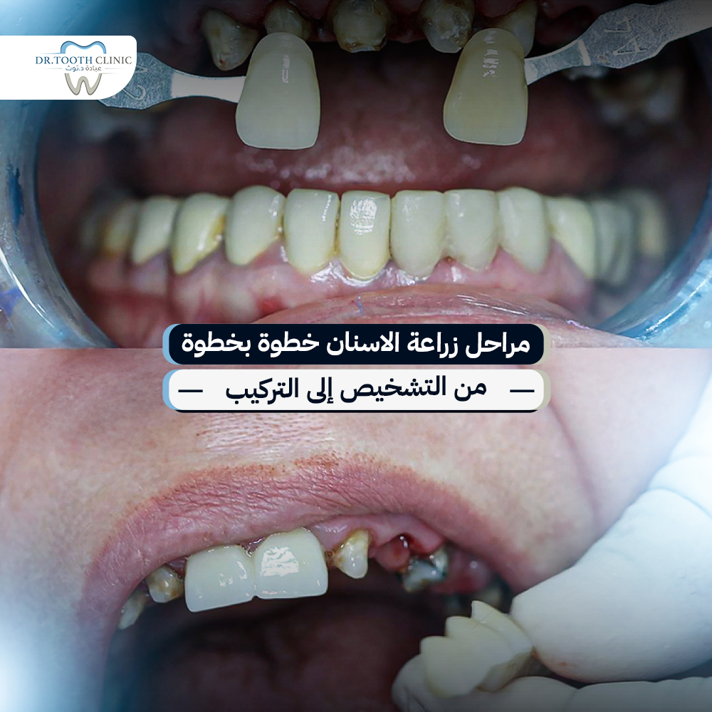 مراحل زراعة الاسنان خطوة بخطوة من التشخيص إلى التركيب