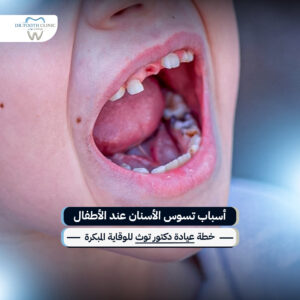 أسباب تسوس الأسنان عند الأطفال وخطة عيادة دكتور توث للوقاية المبكرة