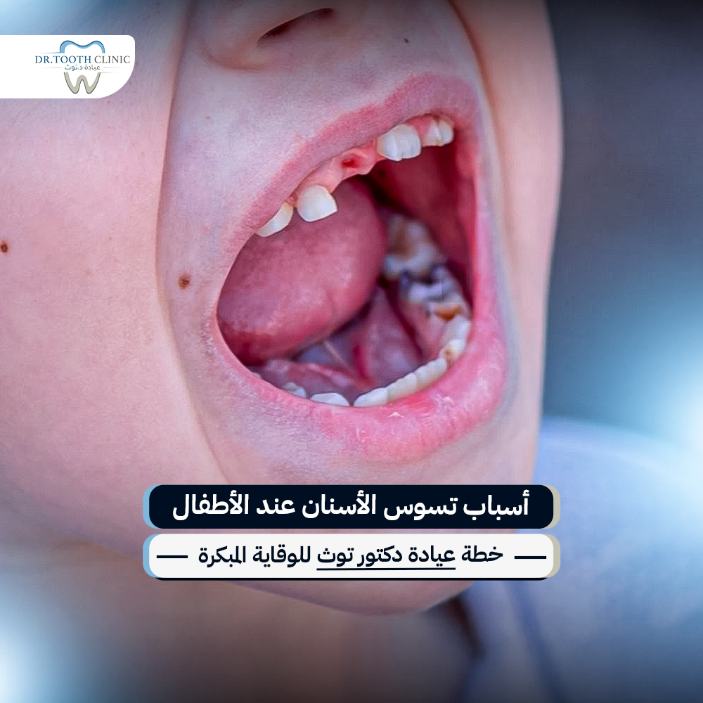أسباب تسوس الأسنان عند الأطفال وخطة عيادة دكتور توث للوقاية المبكرة