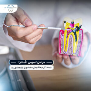 مراحل تسوس الأسنان: علامات كل مرحلة وخيارات العلاج في عيادة دكتور توث