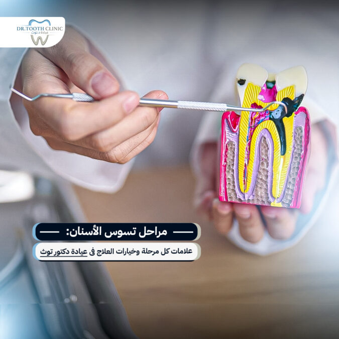 مراحل تسوس الأسنان
