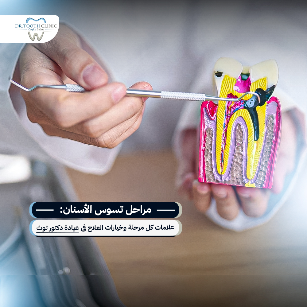 مراحل تسوس الأسنان: علامات كل مرحلة وخيارات العلاج في عيادة دكتور توث