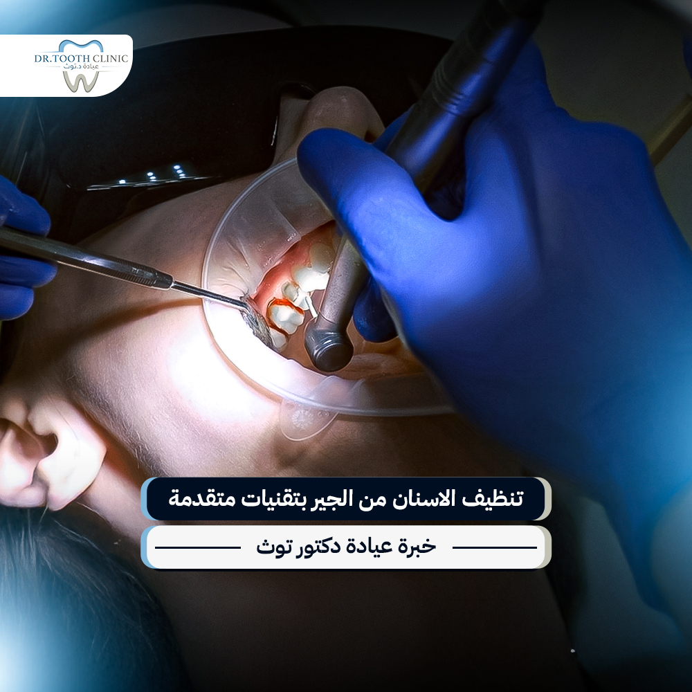 تنظيف الاسنان من الجير بتقنيات متقدمة — خبرة عيادة دكتور توث