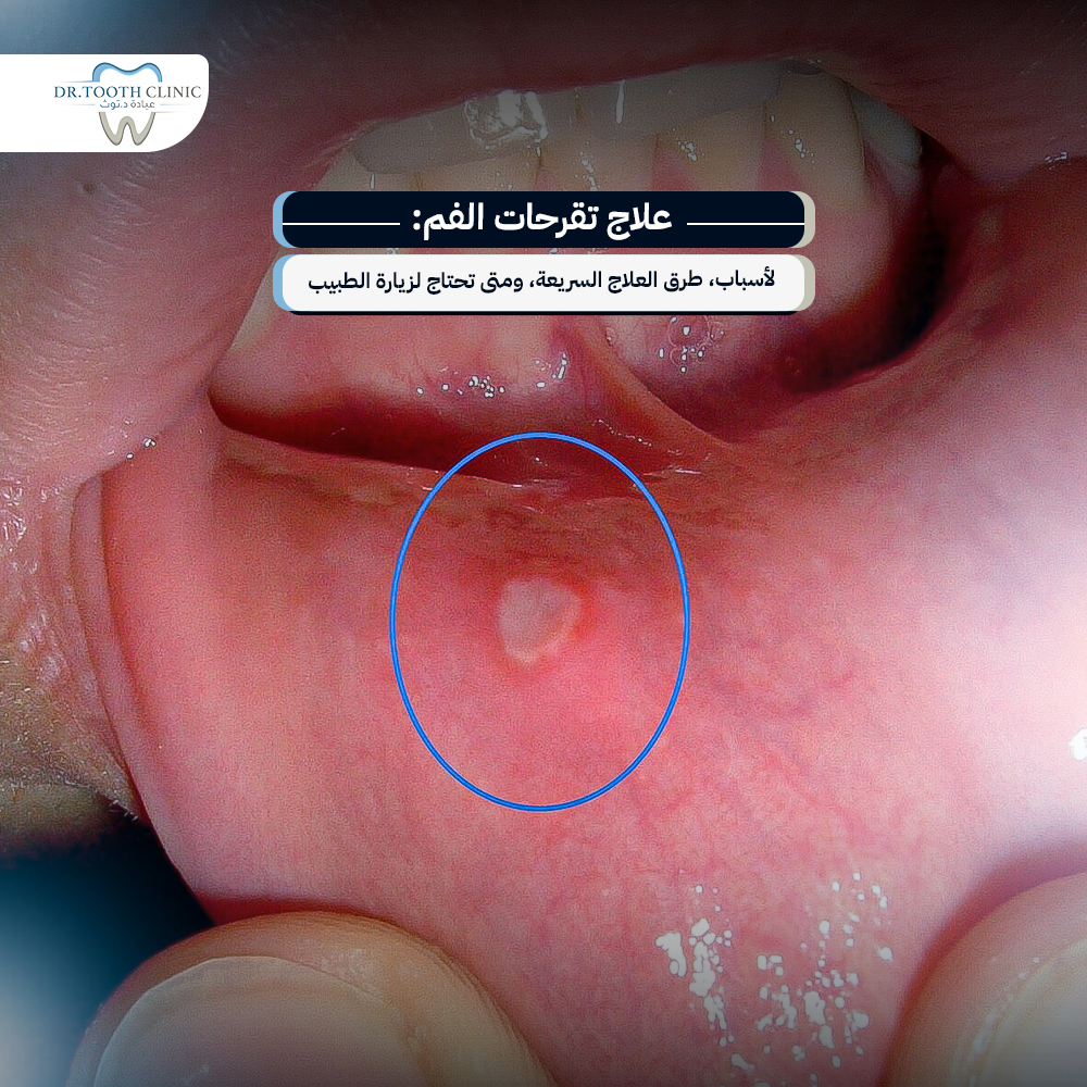 علاج تقرحات الفم: الأسباب، طرق العلاج السريعة، ومتى تحتاج لزيارة الطبيب