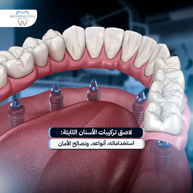 لاصق تركيبات الأسنان الثابتة