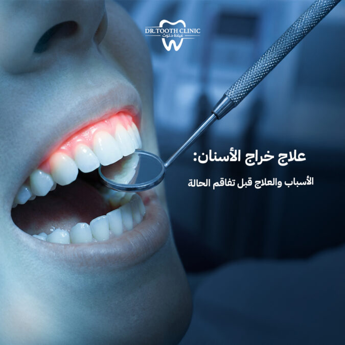 علاج خراج الاسنان