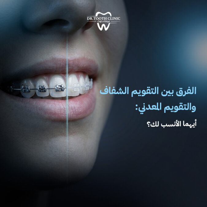 الفرق بين التقويم الشفاف والتقويم المعدني
