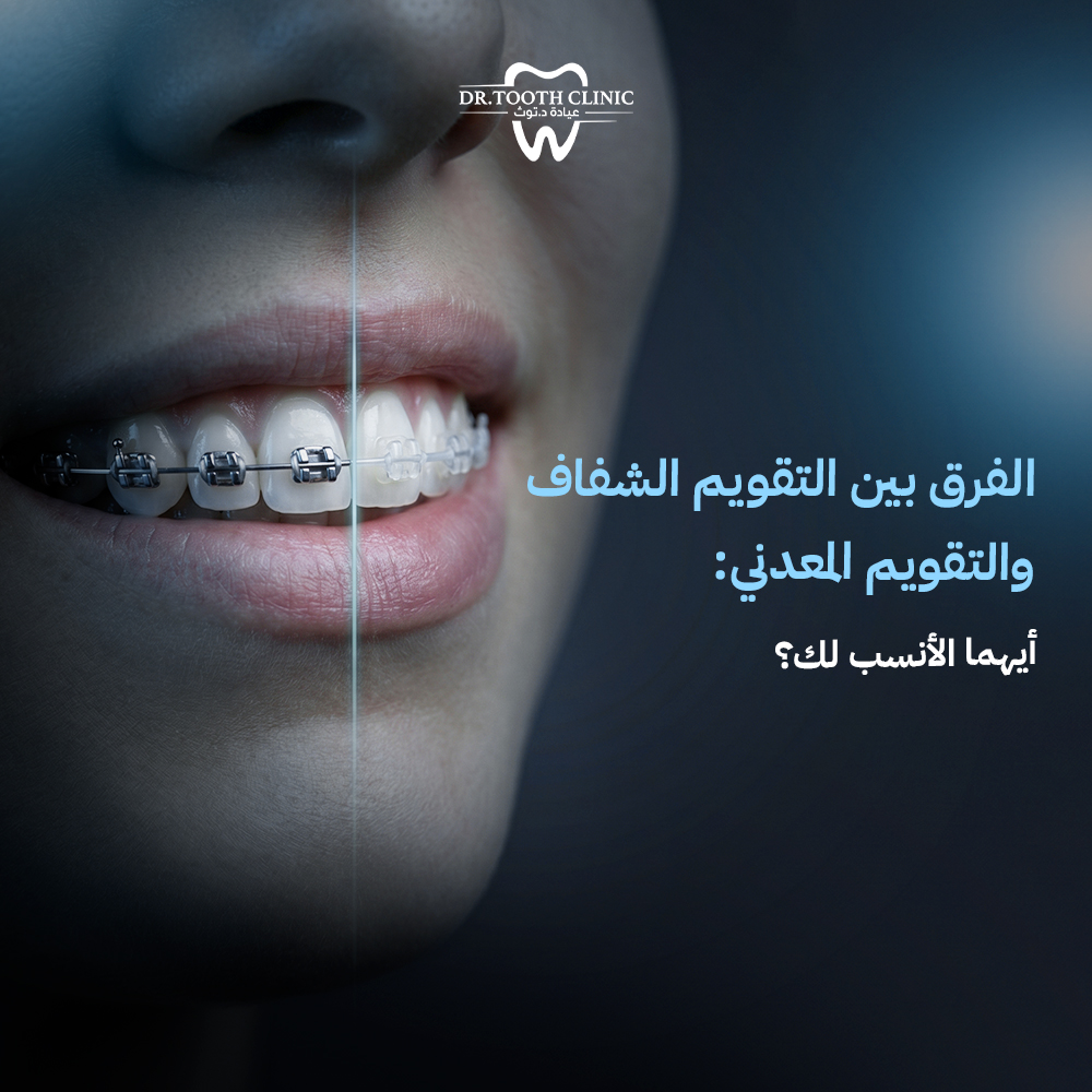 الفرق بين التقويم الشفاف والتقويم المعدني: أيهما الأنسب لك؟
